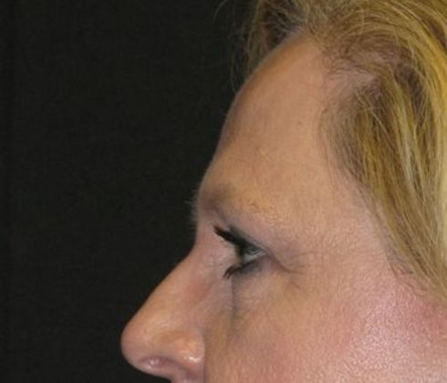 Brow lift: Case 3 - after 8 months