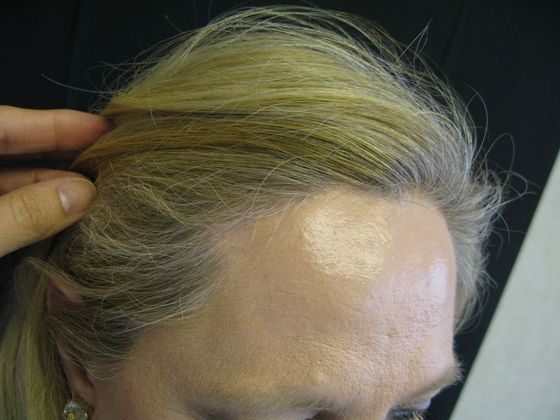 Brow lift: Case 3 - right hairline scar after 8 months