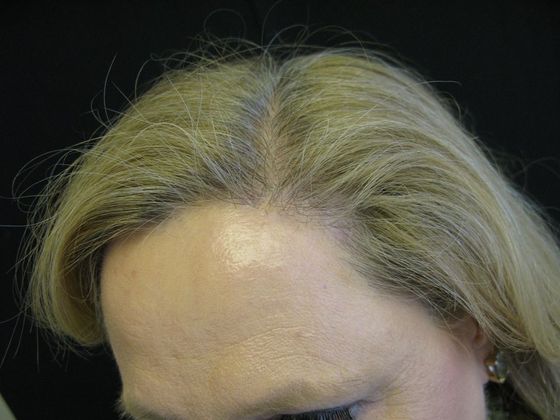 Brow lift: Case 3 - left hairline scar 8 months