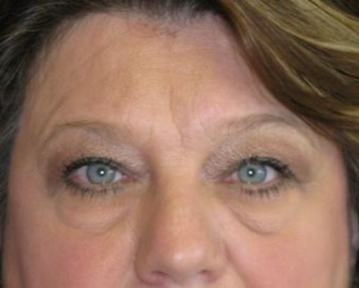 blepharoplasty (eyelid lift) Case 1 - Before