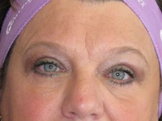 blepharoplasty (eyelid lift) Cases