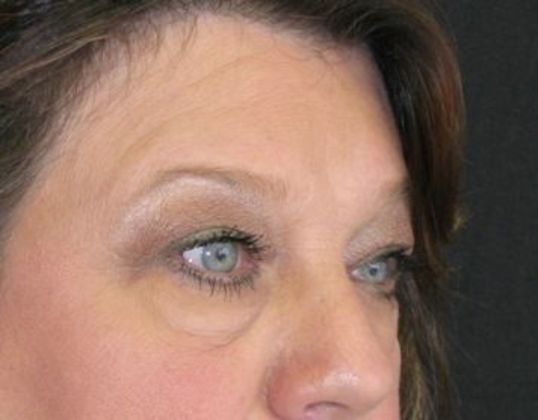 blepharoplasty (eyelid lift): Case 1 - before