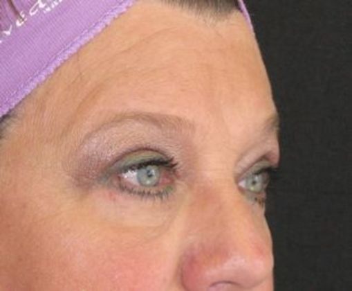 blepharoplasty (eyelid lift): Case 1 - after 3 m