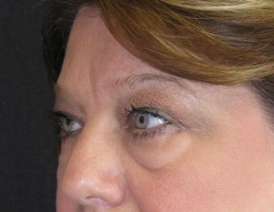 blepharoplasty (eyelid lift): Case 1 - before