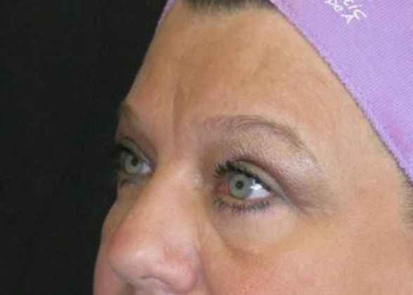 blepharoplasty (eyelid lift): Case 1 - after 3 m