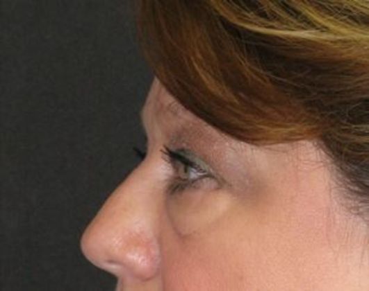 blepharoplasty (eyelid lift): Case 1 - before