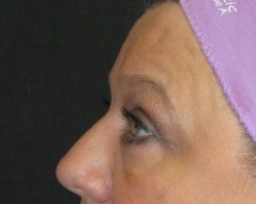 blepharoplasty (eyelid lift): Case 1 - after 3 m