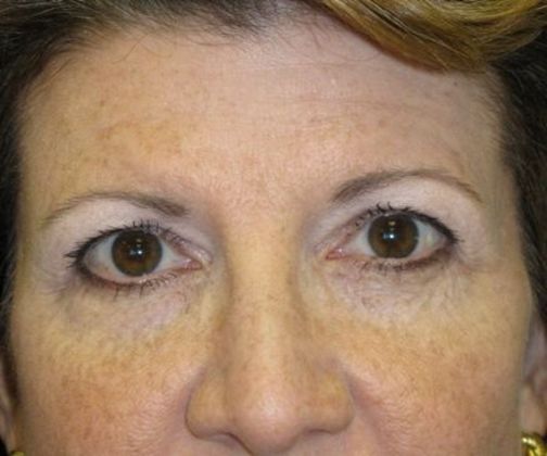 blepharoplasty (eyelid lift): Case 2 - before