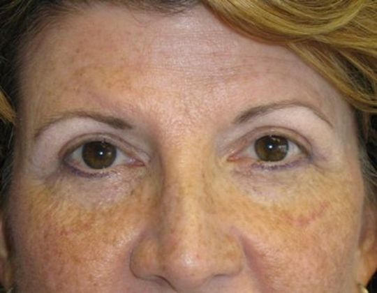 blepharoplasty (eyelid lift): Case 2 - after 1 m