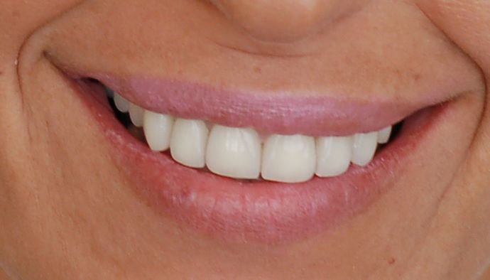 Porcelain Crowns Case 1 - After