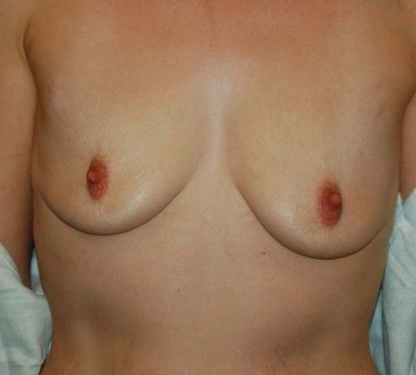 Breast Augmentation w/ Lift Case 17 - Before