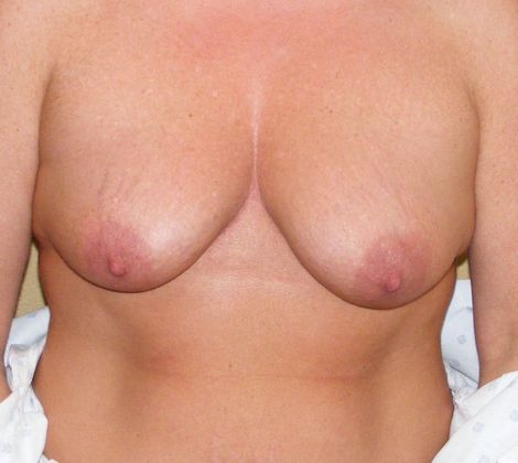 Breast Augmentation w/ Lift Case 91 - Before