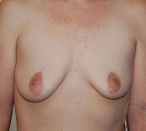 Breast Augmentation w/ Lift: Case 7 - Before