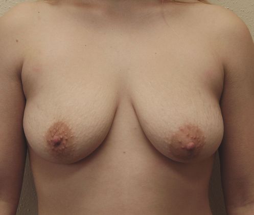 Breast Augmentation w/ Lift: Case 12 - Before