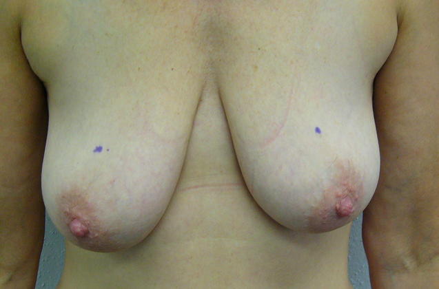 Breast Augmentation w/ Lift: Case 15 - Before