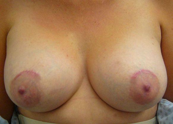 Breast Augmentation w/ Lift Case 601 - After