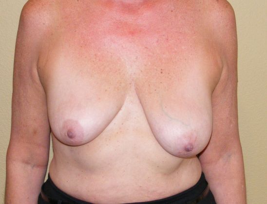 Breast Augmentation w/ Lift: Case 19 - Before