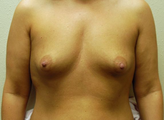 Breast Augmentation w/ Lift: Case 20 - Before