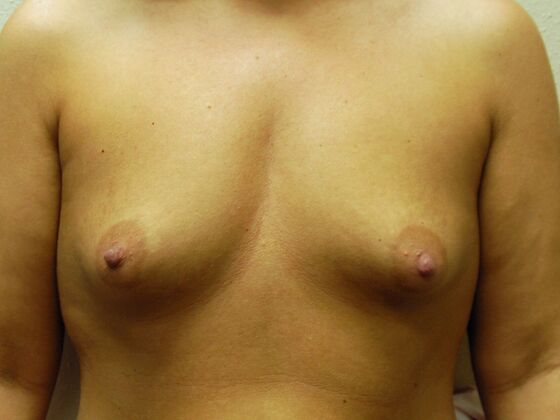 Breast Augmentation w/ Lift Case 20 - Before