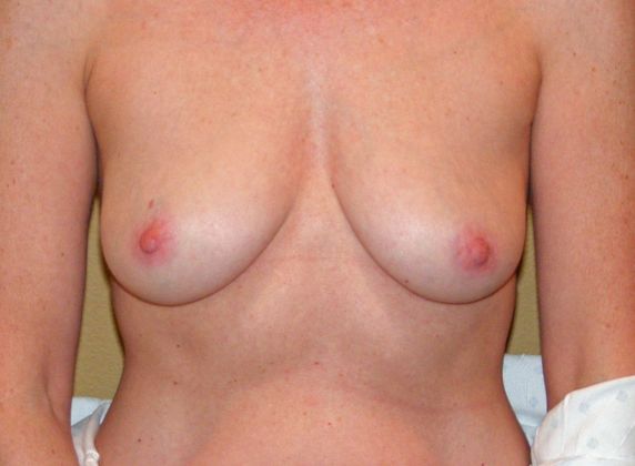 Breast Augmentation w/ Lift: Case 21 - Before