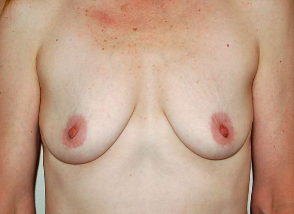 Breast Augmentation w/ Lift: Case 22 - Before