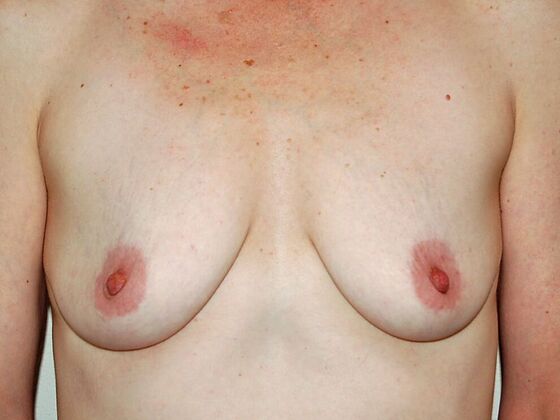 Breast Augmentation w/ Lift Case 22 - Before