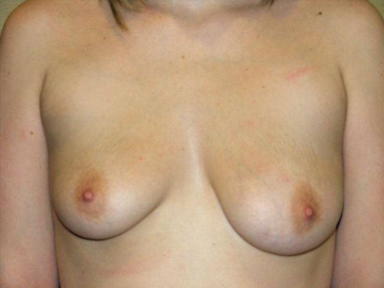 Breast Augmentation w/ Lift: Case 24 - Before