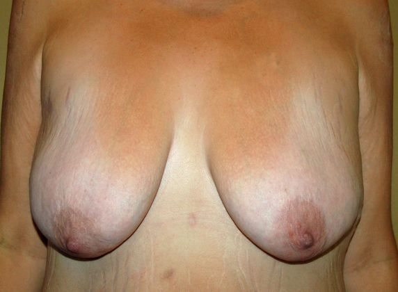 Breast Augmentation w/ Lift: Case 26 - Before