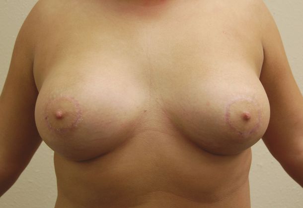 Breast Augmentation w/ Lift Case 28 - After
