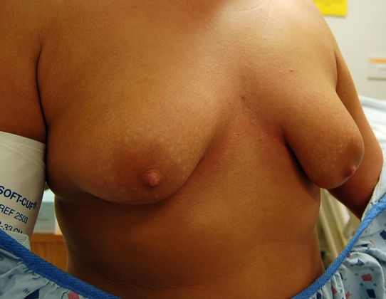 Breast Augmentation w/ Lift: Case 28 - Before