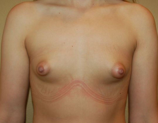 Breast Augmentation w/ Lift Case 3 - Before