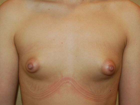 Breast Augmentation w/ Lift Case 62 - Before