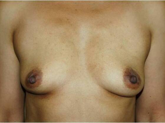 Breast Augmentation: Case 87 - Before