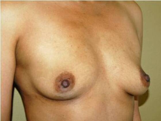 Breast Augmentation: Case 87 - Before
