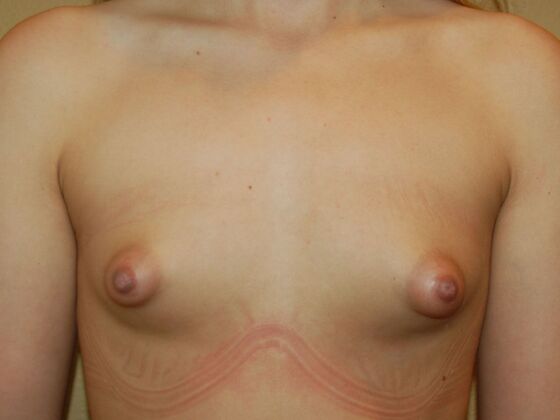 Breast Augmentation: Case 93 - Before