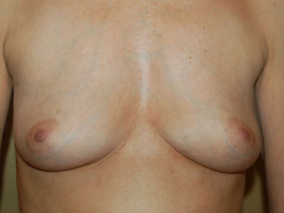 Breast Augmentation: Case 95 - Before