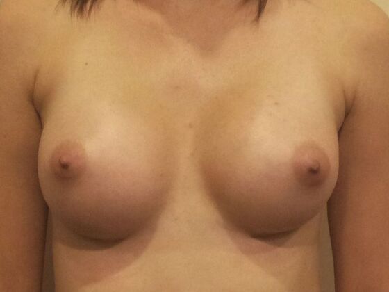 Breast Augmentation: Case 96 - After