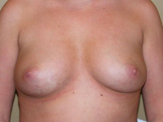 Breast Augmentation: Case 98 - Before