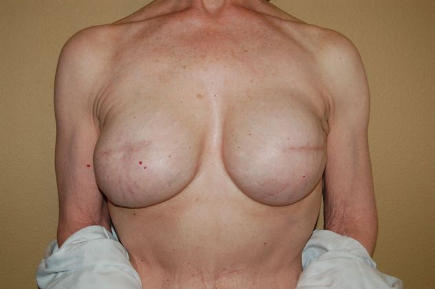Breast Reconstruction Case 16 - After