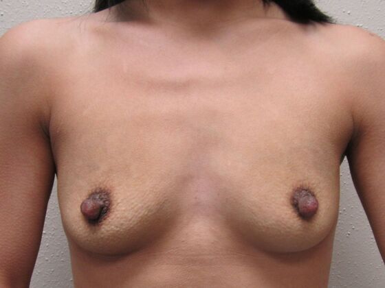 Breast Augmentation: Case 101 - Before