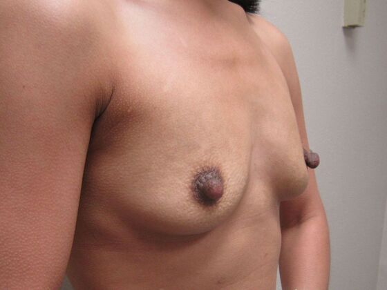 Breast Augmentation: Case 101 - Before