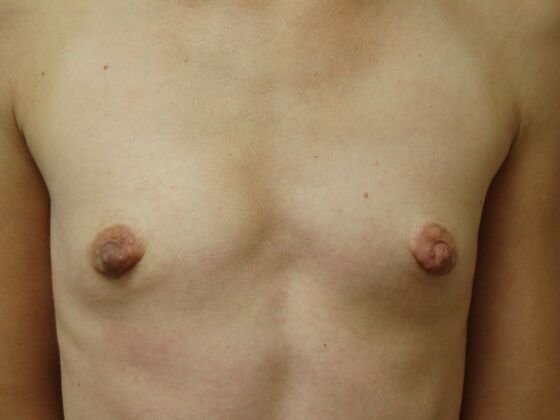 Breast Augmentation: Case 102 - Before