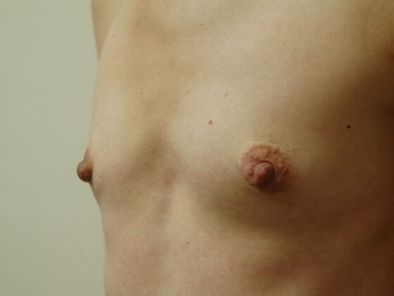 Breast Augmentation: Case 102 - Before
