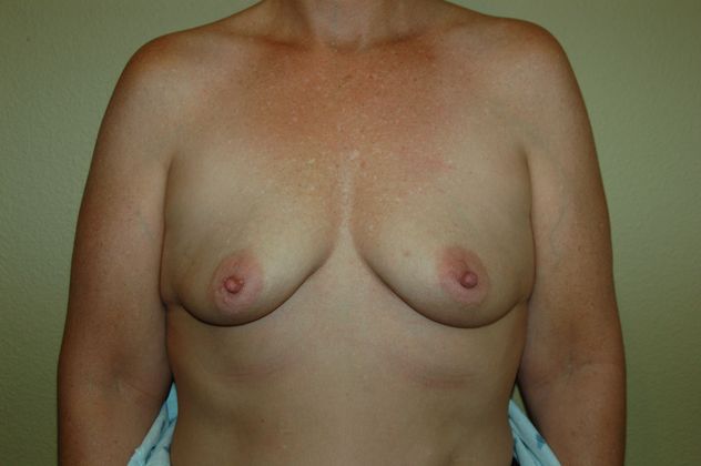 Breast Augmentation w/ Lift: Case 43 - Before