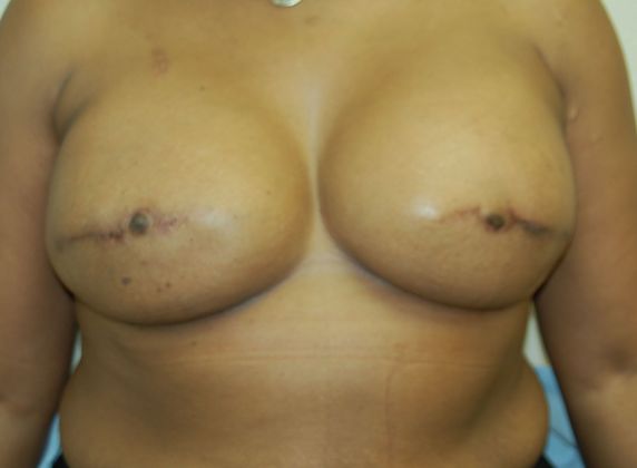 Breast Reconstruction Case 17 - After