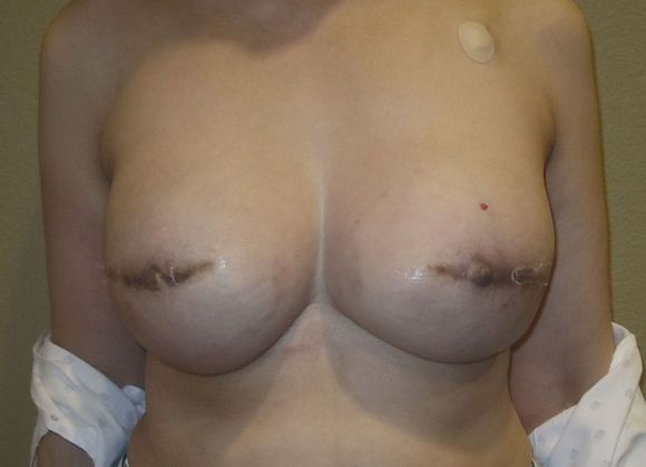 Breast Reconstruction Case 19 - After