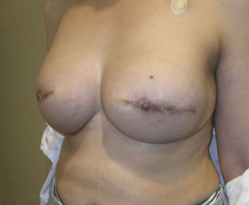 Breast Reconstruction: Case 19 - After