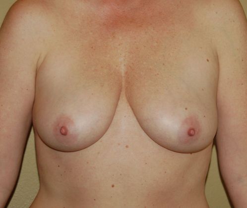 Breast Augmentation w/ Lift Case 45 - Before