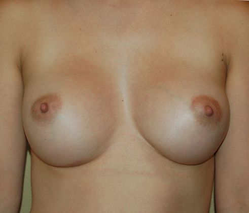 Breast Augmentation Case 106 - After