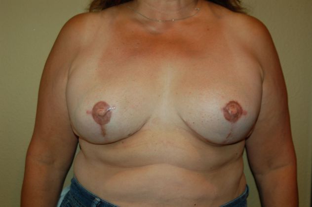 Breast Reconstruction Case 20 - After